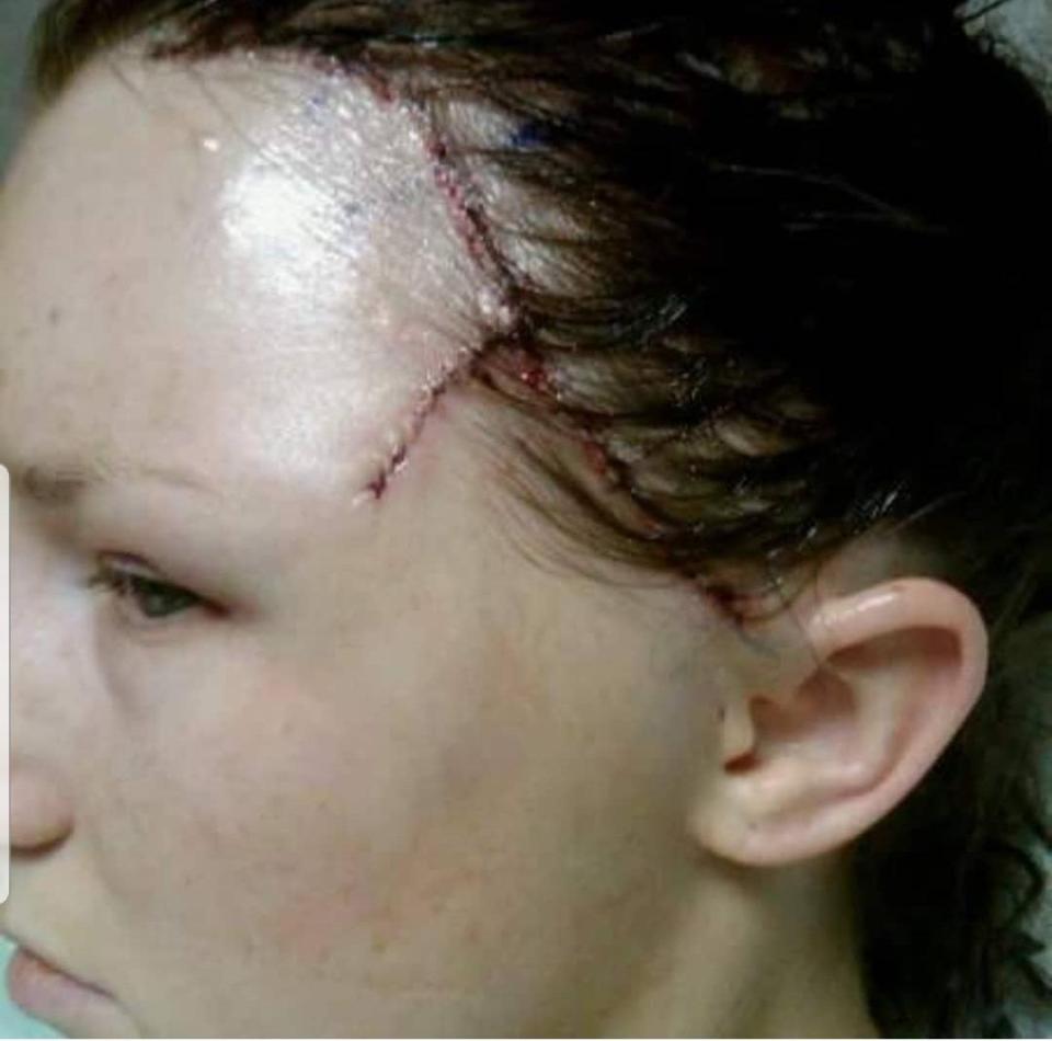  After the surgery, she was left partially paralysed on the left side of her face