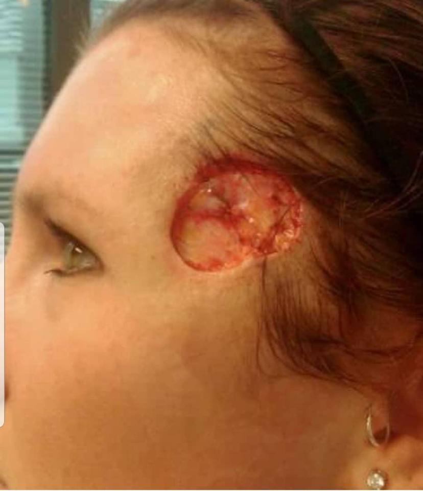  Carrie was left with a huge hole in her face after having a cancerous scab removed