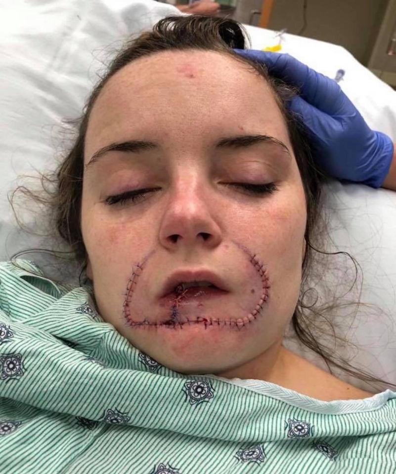  Kayla Hayes was left with permanent scarring after he ex-boyfriend tore her lip off