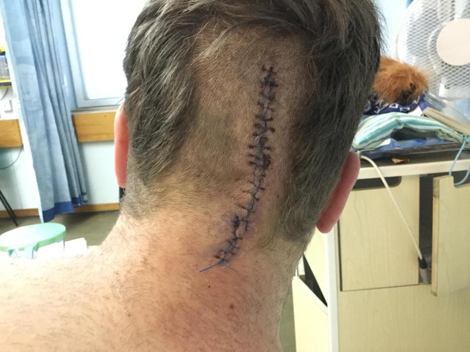 Neil had surgery to remove the plum-sized brain tumour in December 2016