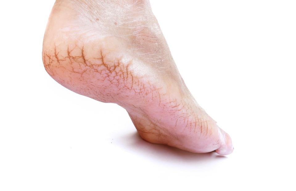 If your feet are constantly dry and cracked it could be a symptom of hyperkeratosis