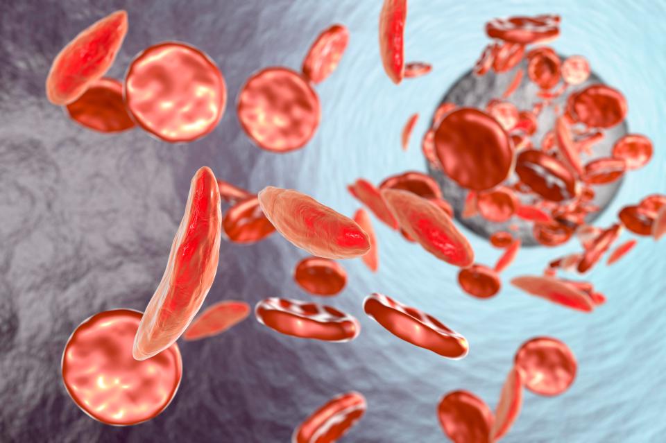  Sickle cell disease affects the red blood cells and can cause attacks of pain