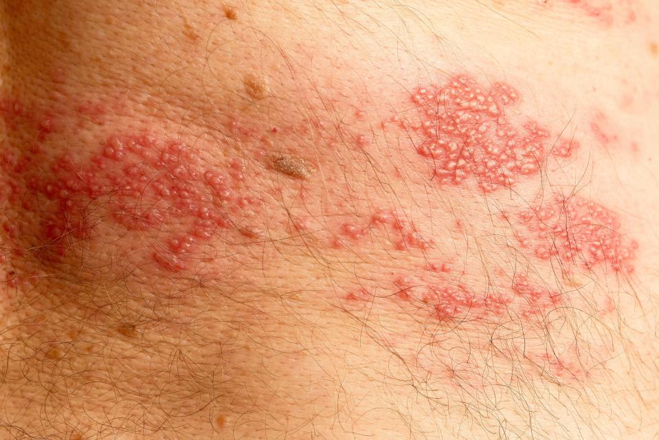  Shingles usually appears as a rash along the waistline and can cause intense burning or tingling