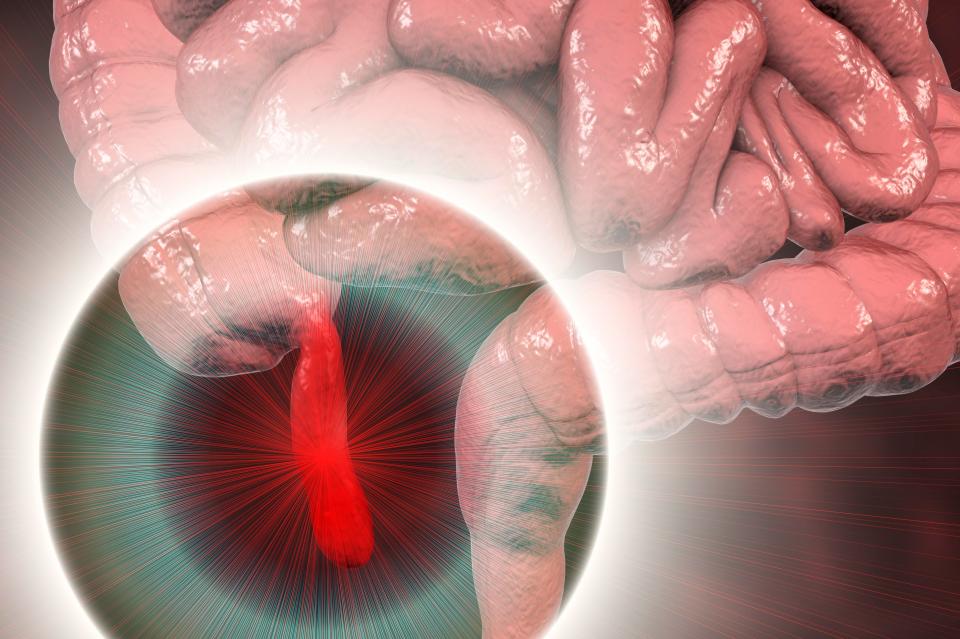  Appendicitis is when the appendix becomes swollen and inflamed