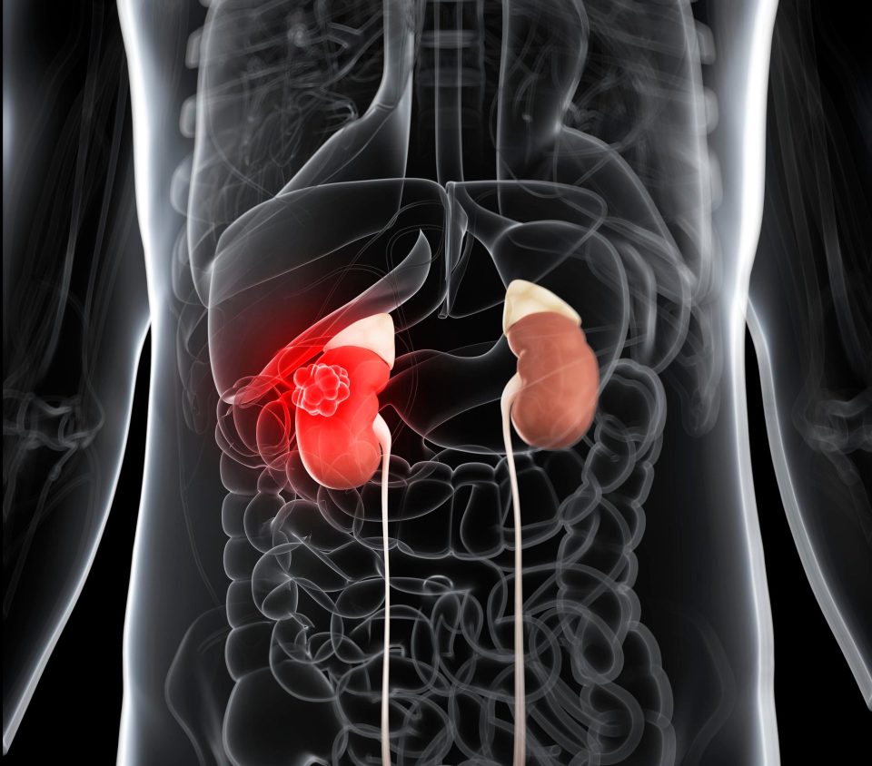  This type of kidney cancer can cause weight loss and a swollen tummy