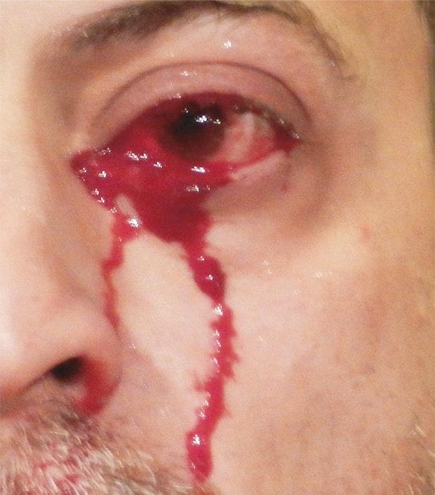  The man was unable to explain why his eyes were bleeding at first