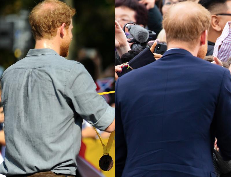  Prince Harry's bald patch has DOUBLED in the last year - as these pics from the 2017 Invictus Games ceremony, left, and in Australia last month, right, show