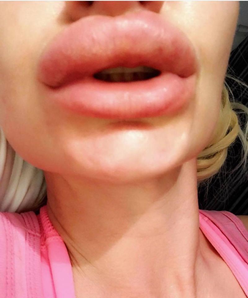 Kerry said her lips looked like 'bits of liver' and took three weeks to calm down