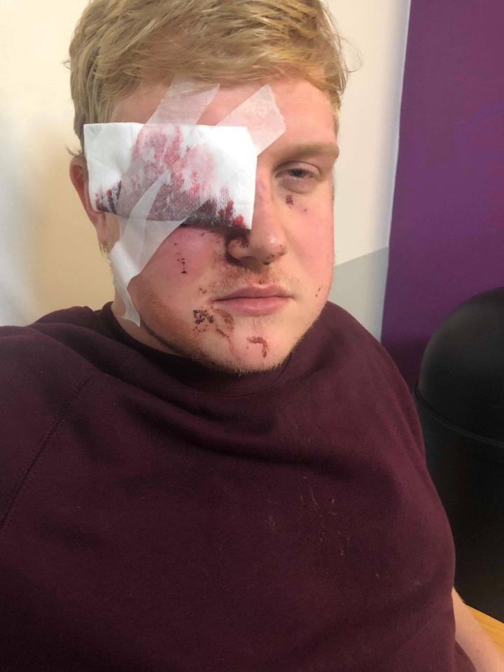  He was taken to Milton Keynes A&E and treated for multiple facial injuries