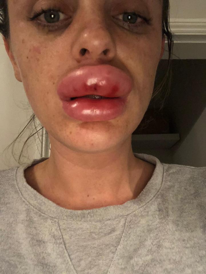  Rachael Knappier previously told Fabulous Digital how she had botched fillers at a party