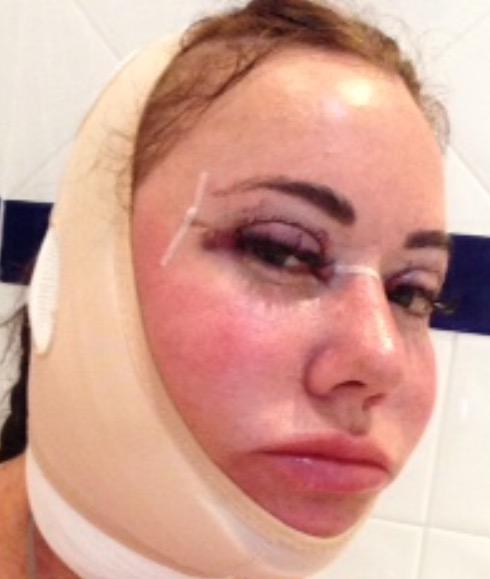  Lisa Appleton has admitted she regrets having her last facelift