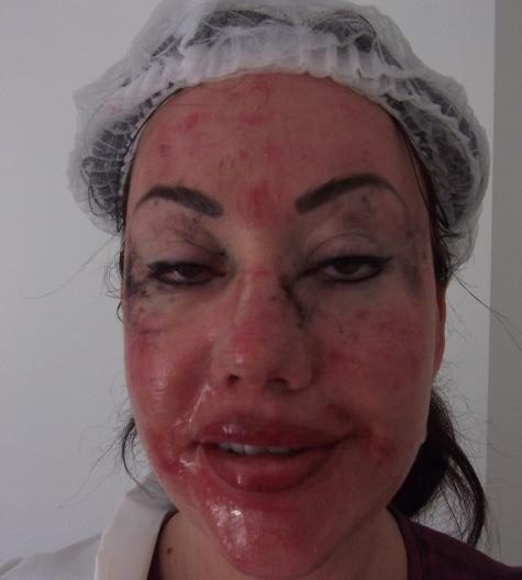  Lisa Appleton underwent an acid peel in Thailand