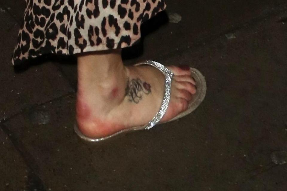  Faye's heel is blistered and bruised