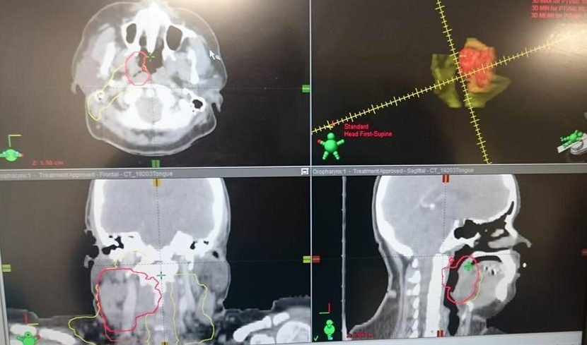  Scans show the tumour in Clare's throat and lymph nodes