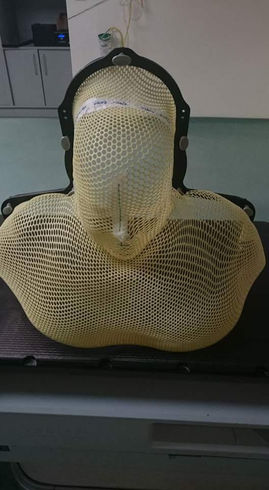  Clare had a mask made for her radiotherapy treatment, which left her covered in burns and blisters