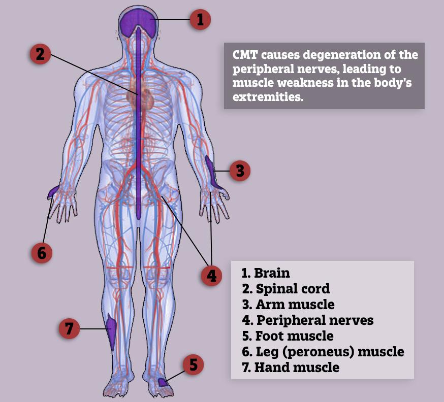 This is how Charcot-Marie-Tooth (CMT) disease affects the body, slowly getting worse every single day