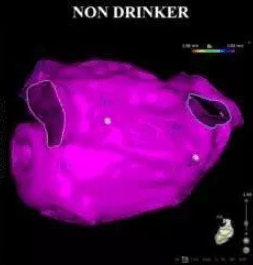  A nondrinker's heart