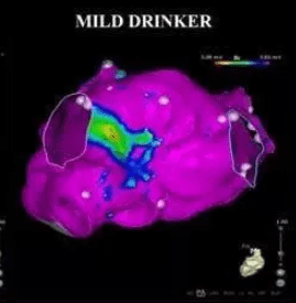  A mild drinker's heart (around seven glasses a week)