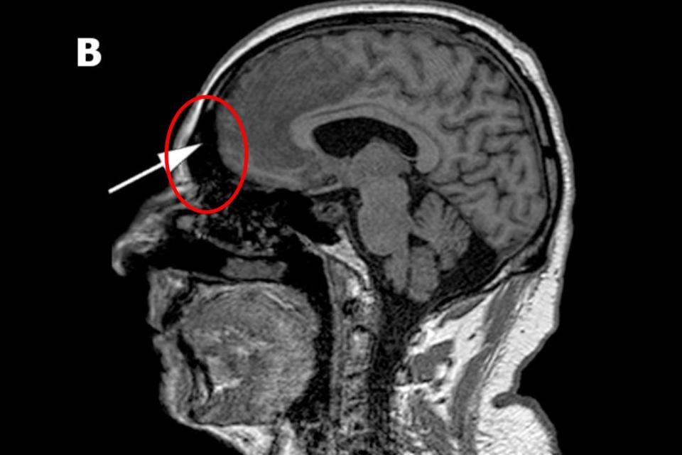 His bizarre personality changes, which saw him masturbate in front of his family, were caused by the brain damage from the stroke