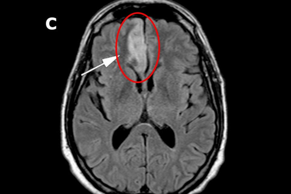 A man who began 'masturbating inappropriately' was found to have suffered a 'silent' stroke