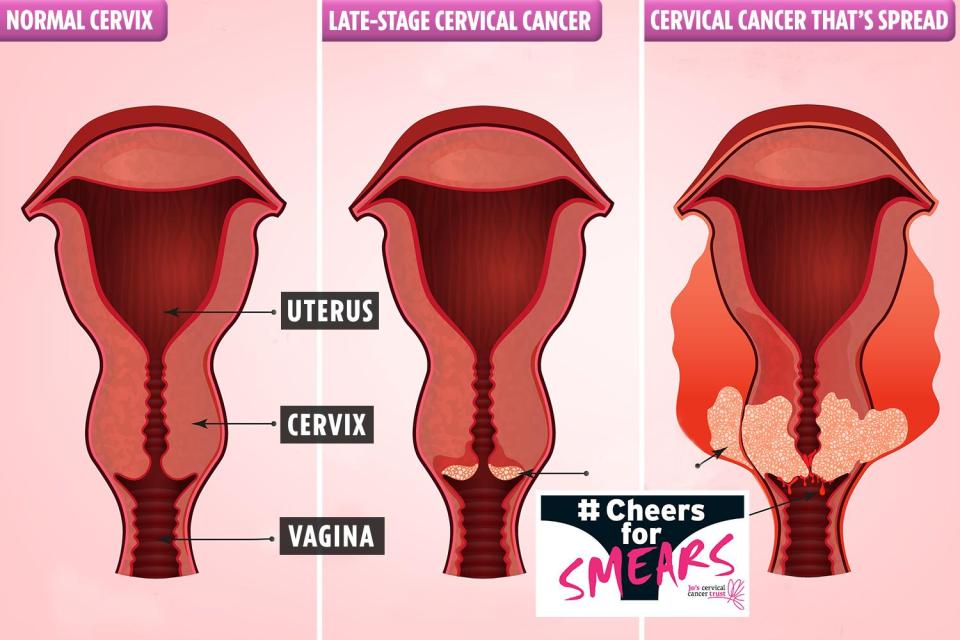 There are a range of symptoms that are consistent with cervical cancer - it's important you know the signs 