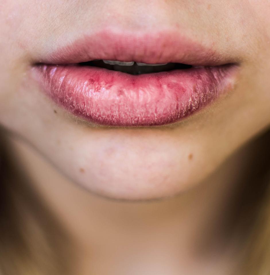  Cracked lips could be a sign of a weak immune system or an auto-immune disease