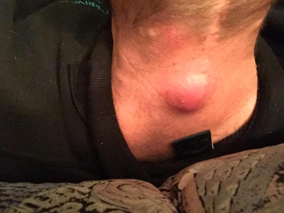  The abscess on Scott's neck that forced emergency surgery