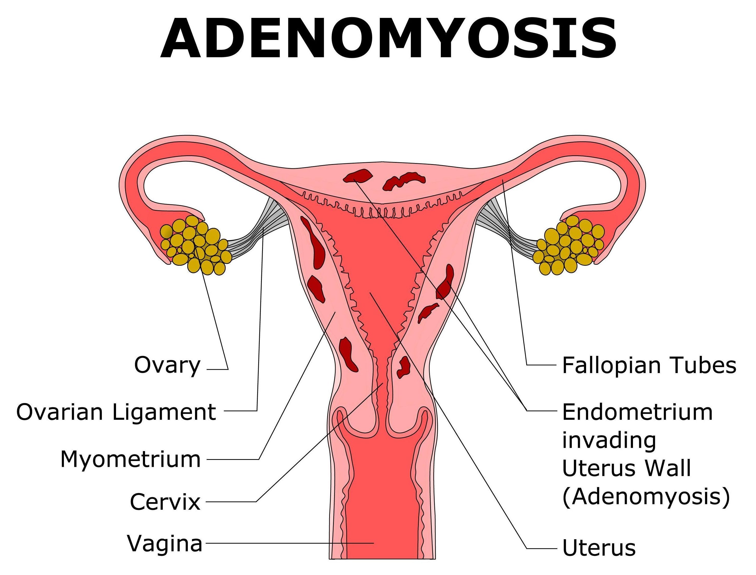  Adenomyosis is a condition of the uterus, where the tissue that grows on the lining of the uterus is also present on the inside muscular wall of the uterus