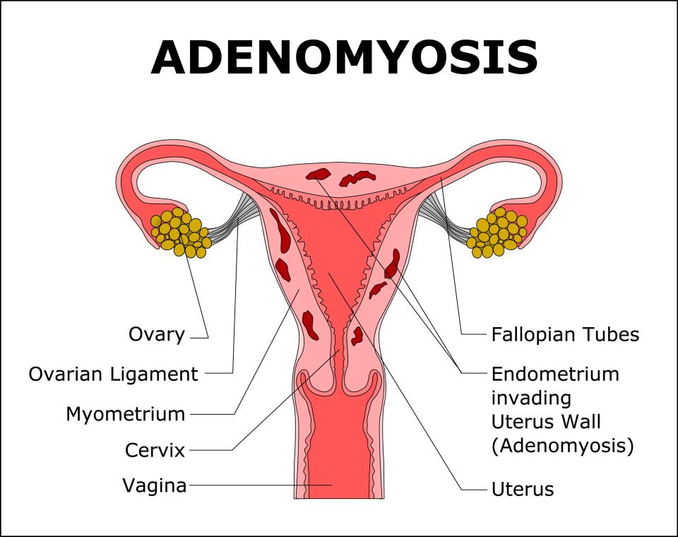  Adenomyosis is a condition of the uterus, where the tissue that grows on the lining of the uterus is also present on the inside muscular wall of the uterus