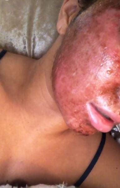  She got the facial to tackle scarring from impetigo