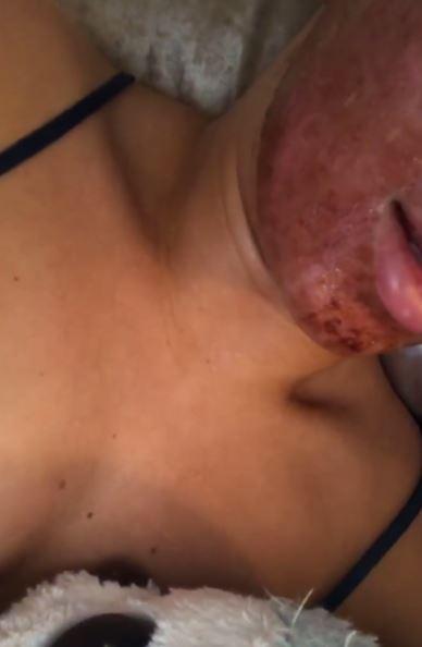  Alexandra's skin looked very red and inflamed after the facial