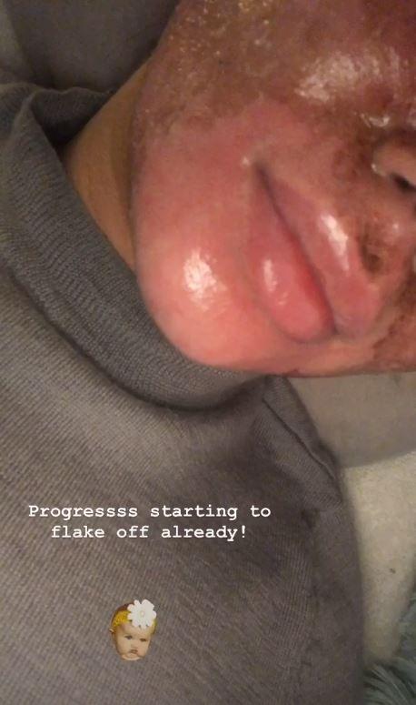  Alex updated her fans with how her skin was healing