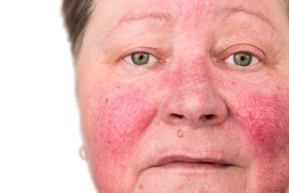  Symptoms of rosacea often begin with episodes of skin flushing before getting worse