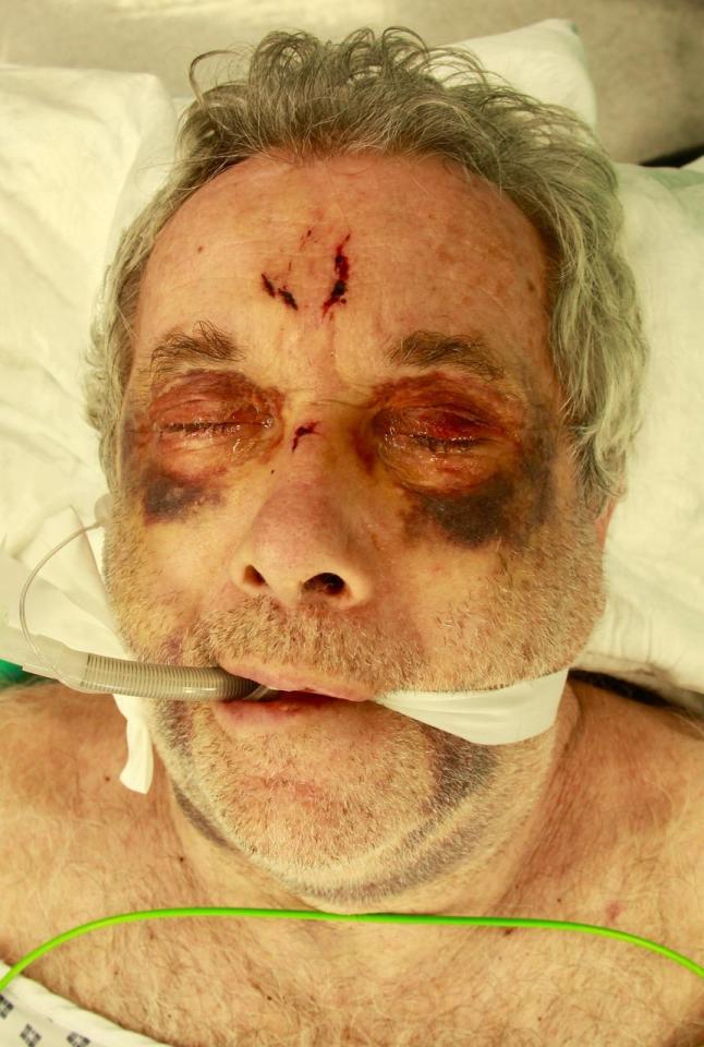  Martin Bell fractured his upper jawbone, both eye sockets, nose and an area at the base of his skull in the fall