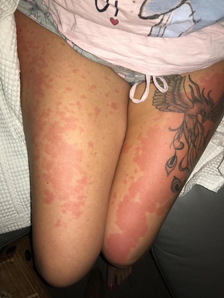  It develops on her legs and upper body - often feeling as though her skin is burning