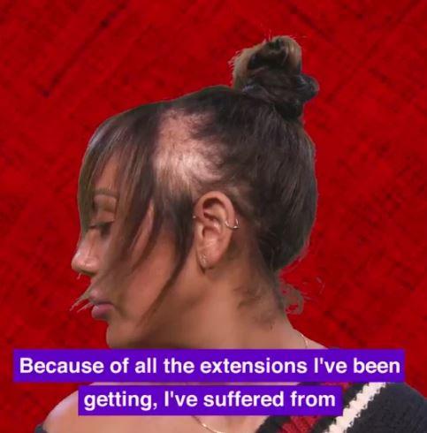  Geordie Shore star Sophie Kasaei has opened up about how she's suffered from alopecia thanks to extensions