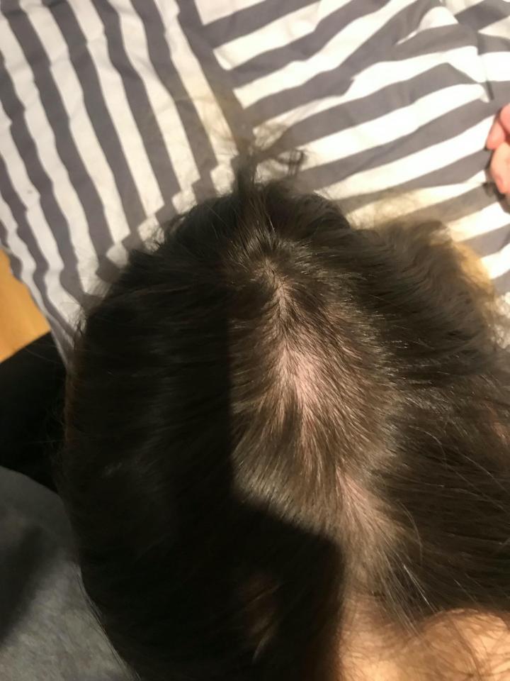  But she claims that it left her with a massive bald patch