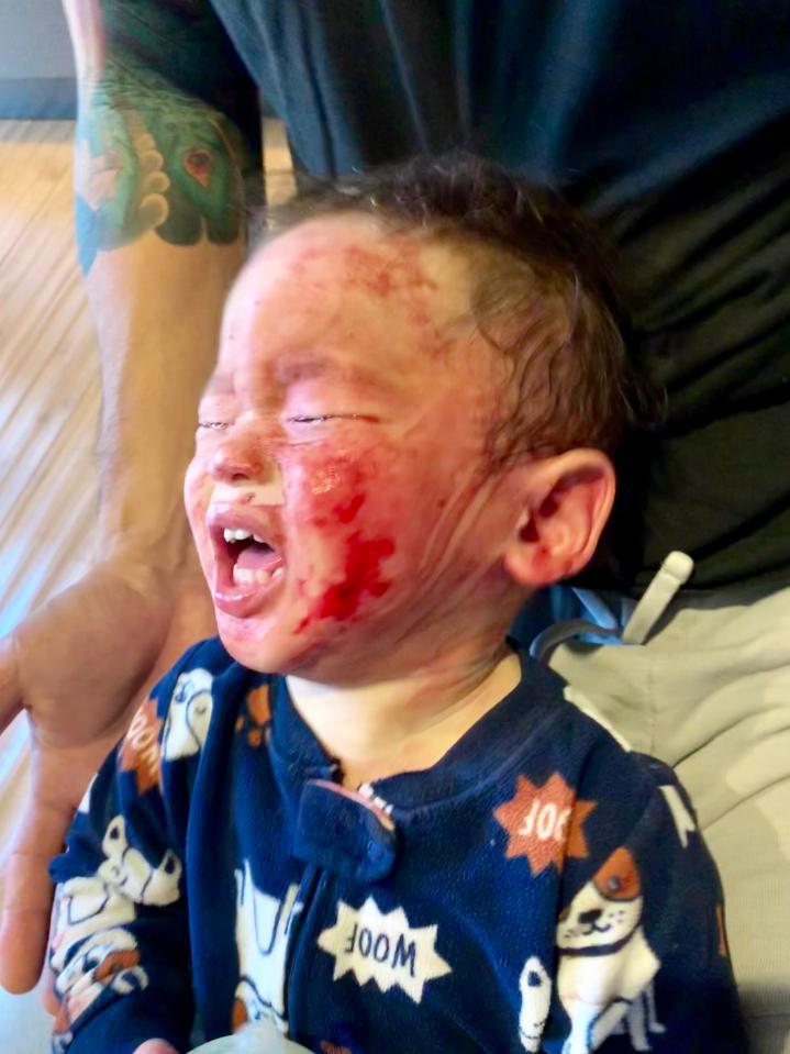  Little Colby Chun was left screaming in agony after suffering a severe reaction to eczema cream