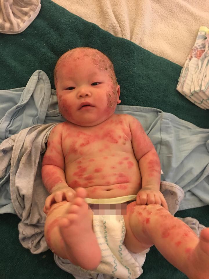  The toddler suffered topical steroid withdrawal, a severe allergic reaction