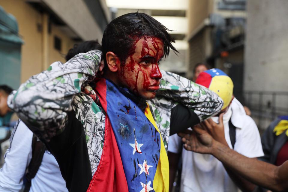  A wounded protester stands his ground as thousands take to the streets against President Maduro in Caracas