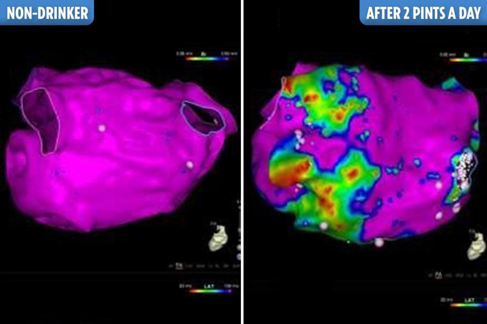 These scans reveal the damage even moderate drinking can do to your heart - raising your risk of atrial fibrillation - a major cause of stroke