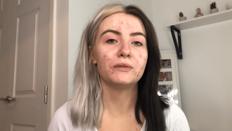  In a YouTube video, Abbie explained that her skin had got her down, had made it hard to eat and talk, and had discouraged her from leaving the house