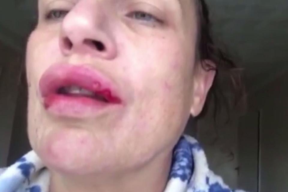  Tracy Bates has shared a harrowing video of her oozing lip fillers