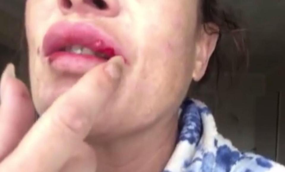  The mum-of-three had made a number of holes in her lips