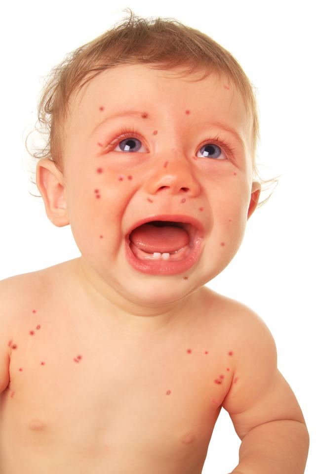 Measles infections reached a ten years high as 'anti-vaccine movement' scares parents away