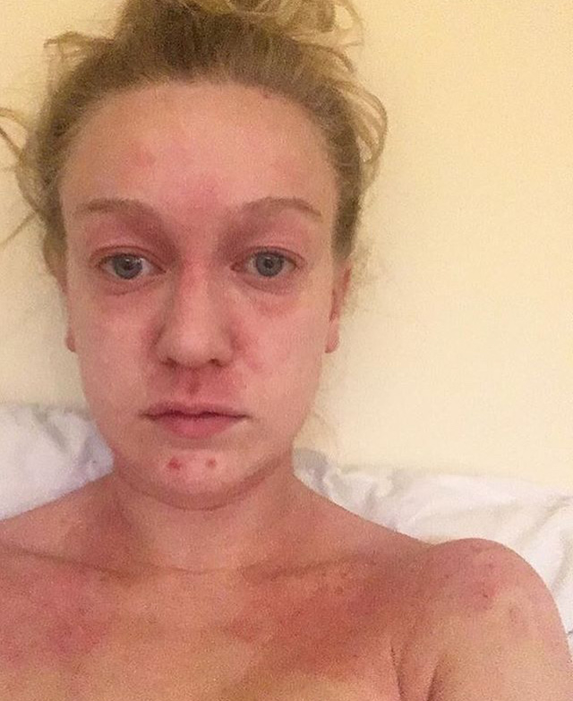 Amy has suffered from severe eczema since childhood