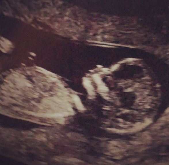  Stacey shared a photo of the baby scan