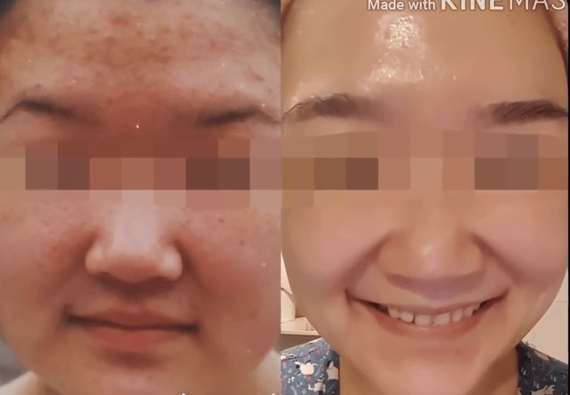  The woman said her face has transformed thanks to the treatment