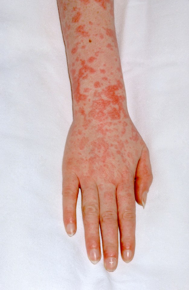  More than 480 cases of scarlet fever have now been reported across England and Wales