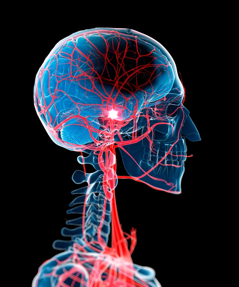 The woman's imminent orgasm caused a small aneurysm - balloon on a blood vessel - to burst, causing a mini stroke